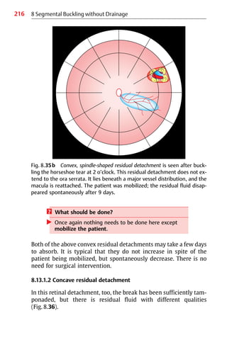 216 8 Segmental Buckling without Drainage
Fig. 8.35b Convex, spindle-shaped residual detachment is seen after buck-
ling the horseshoe tear at 2 o’clock. This residual detachment does not ex-
tend to the ora serrata. It lies beneath a major vessel distribution, and the
macula is reattached. The patient was mobilized; the residual fluid disap-
peared spontaneously after 9 days.
? What should be done?
왘 Once again nothing needs to be done here except
mobilize the patient.
Both of the above convex residual detachments may take a few days
to absorb. It is typical that they do not increase in spite of the
patient being mobilized, but spontaneously decrease. There is no
need for surgical intervention.
8.13.1.2 Concave residual detachment
In this retinal detachment, too, the break has been sufficiently tam-
ponaded, but there is residual fluid with different qualities
(Fig. 8.36).
 