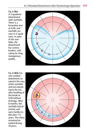 217
8.13 Residual Detachment after Nondrainage Operation
Fig. 8.36a
A 3-quadrant
detachment
with starfolds.
There is a
horseshoe tear
at 9:30, and
starfolds are
seen in 2 quad-
rants. In spite
of the star-
folds, the
detachment
has convex
borders, indi-
cating its rheg-
matogenous
quality.
Fig. 8.36b Con-
cave residual
detachment, lo-
cated in the area
of the starfolds
and not extend-
ing to the ora,
after buckling of
the break at
9:30 without
drainage. After
6 months, the
starfolds had at-
tached, and
were hardly vis-
ible after 11/2
years. The retina
remained at-
tached during
16 years.
 