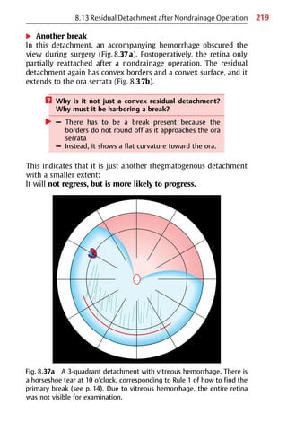 219
8.13 Residual Detachment after Nondrainage Operation
왘 Another break
In this detachment, an accompanying hemorrhage obscured the
view during surgery (Fig. 8.37a). Postoperatively, the retina only
partially reattached after a nondrainage operation. The residual
detachment again has convex borders and a convex surface, and it
extends to the ora serrata (Fig. 8.37b).
? Why is it not just a convex residual detachment?
Why must it be harboring a break?
왘 – There has to be a break present because the
borders do not round off as it approaches the ora
serrata
– Instead, it shows a flat curvature toward the ora.
This indicates that it is just another rhegmatogenous detachment
with a smaller extent:
It will not regress, but is more likely to progress.
Fig. 8.37a A 3-quadrant detachment with vitreous hemorrhage. There is
a horseshoe tear at 10 o’clock, corresponding to Rule 1 of how to find the
primary break (see p. 14). Due to vitreous hemorrhage, the entire retina
was not visible for examination.
 