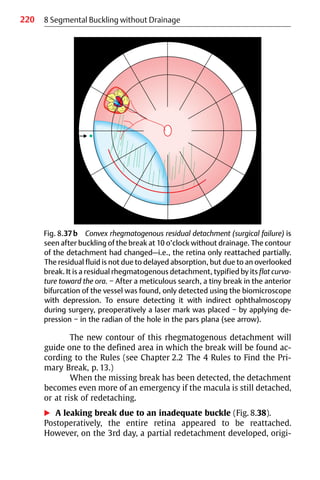 220 8 Segmental Buckling without Drainage
Fig. 8.37b Convex rhegmatogenous residual detachment (surgical failure) is
seen after buckling of the break at 10 o’clock without drainage. The contour
of the detachment had changed—i.e., the retina only reattached partially.
The residual fluid is not due to delayed absorption, but due to an overlooked
break. It is a residual rhegmatogenous detachment, typified by its flat curva-
ture toward the ora. − After a meticulous search, a tiny break in the anterior
bifurcation of the vessel was found, only detected using the biomicroscope
with depression. To ensure detecting it with indirect ophthalmoscopy
during surgery, preoperatively a laser mark was placed − by applying de-
pression − in the radian of the hole in the pars plana (see arrow).
The new contour of this rhegmatogenous detachment will
guide one to the defined area in which the break will be found ac-
cording to the Rules (see Chapter 2.2 The 4 Rules to Find the Pri-
mary Break, p. 13.)
When the missing break has been detected, the detachment
becomes even more of an emergency if the macula is still detached,
or at risk of redetaching.
왘 A leaking break due to an inadequate buckle (Fig. 8.38).
Postoperatively, the entire retina appeared to be reattached.
However, on the 3rd day, a partial redetachment developed, origi-
 