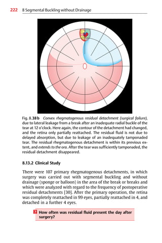 222 8 Segmental Buckling without Drainage
Fig. 8.38b Convex rhegmatogenous residual detachment (surgical failure),
due to lateral leakage from a break after an inadequate radial buckle of the
tear at 12 o’clock. Here again, the contour of the detachment had changed,
and the retina only partially reattached. The residual fluid is not due to
delayed absorption, but due to leakage of an inadequately tamponaded
tear. The residual rhegmatogenous detachment is within its previous ex-
tent, and extends to the ora. After the tear was sufficiently tamponaded, the
residual detachment disappeared.
8.13.2 Clinical Study
There were 107 primary rhegmatogenous detachments, in which
surgery was carried out with segmental buckling and without
drainage (sponge or balloon) in the area of the break or breaks and
which were analyzed with regard to the frequency of postoperative
residual detachments [30]. After the primary operation, the retina
was completely reattached in 99 eyes, partially reattached in 4, and
detached in a further 4 eyes.
? How often was residual fluid present the day after
surgery?
 