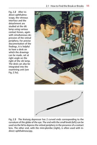 11
Fig. 2.2 After in-
direct ophthalmo-
scopy, the vitreous
interface and the
detachment are
studied at the slit
lamp using various
contact lenses, again
with simultaneous de-
pression of the retinal
periphery. For precise
documentation of the
findings, it is helpful
to have a desk on
which the drawings
can be made, set at
right angle on the
right of the slit lamp.
The desk can also be
integrated into the
examining unit (see
Fig. 2.1a).
Fig. 2.3 The Kreissig depressor has 2 curved ends corresponding to the
curvature of the globe of the eye. The end with the small knob (left) can be
used via the lid to depress the retinal periphery in the presence of a contact
lens. The other end, with the mini-plombe (right), is often used with in-
direct ophthalmoscopy.
2.1 How to Find the Break or Breaks
 