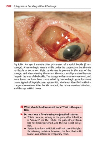 228 8 Segmental Buckling without Drainage
Fig. 8.39 An eye 6 months after placement of a radial buckle (7 mm
sponge). A hemorrhagic mass is visible under the conjunctiva, but there is
no fistula or secretion. Slight tenderness is present in the area of the
sponge, and when viewing the retina, there is a small preretinal hemor-
rhage in the area of the buckle. The sponge and sutures were removed, and
were found to have been surrounded by hemorrhagic granulomatous
tissue, typical of Staphylococcus epidermidis, which was identified in the in-
traoperative culture. After buckle removal, the retina remained attached,
and the eye settled down.
? What should be done or not done? That is the ques-
tion.
왘 Do not close a fistula using conjunctival sutures.
– This is because, as long as the parabulbar infection
is “drained” via the fistula, the patient’s problem
has not been worsened, and the eye is not put at
risk.
– Systemic or local antibiotics will not cure this sight-
threatening problem; however, the best that anti-
biotics can achieve is temporary relief.
 