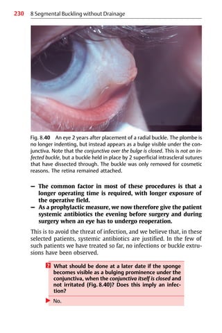 230 8 Segmental Buckling without Drainage
Fig. 8.40 An eye 2 years after placement of a radial buckle. The plombe is
no longer indenting, but instead appears as a bulge visible under the con-
junctiva. Note that the conjunctiva over the bulge is closed. This is not an in-
fected buckle, but a buckle held in place by 2 superficial intrascleral sutures
that have dissected through. The buckle was only removed for cosmetic
reasons. The retina remained attached.
– The common factor in most of these procedures is that a
longer operating time is required, with longer exposure of
the operative field.
– As a prophylactic measure, we now therefore give the patient
systemic antibiotics the evening before surgery and during
surgery when an eye has to undergo reoperation.
This is to avoid the threat of infection, and we believe that, in these
selected patients, systemic antibiotics are justified. In the few of
such patients we have treated so far, no infections or buckle extru-
sions have been observed.
? What should be done at a later date if the sponge
becomes visible as a bulging prominence under the
conjunctiva, when the conjunctiva itself is closed and
not irritated (Fig. 8.40)? Does this imply an infec-
tion?
왘 No.
 