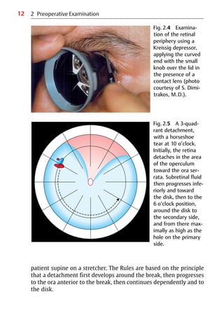 12
Fig. 2.5 A 3-quad-
rant detachment,
with a horseshoe
tear at 10 o’clock.
Initially, the retina
detaches in the area
of the operculum
toward the ora ser-
rata. Subretinal fluid
then progresses infe-
riorly and toward
the disk, then to the
6 o’clock position,
around the disk to
the secondary side,
and from there max-
imally as high as the
hole on the primary
side.
patient supine on a stretcher. The Rules are based on the principle
that a detachment first develops around the break, then progresses
to the ora anterior to the break, then continues dependently and to
the disk.
2 Preoperative Examination
Fig. 2.4 Examina-
tion of the retinal
periphery using a
Kreissig depressor,
applying the curved
end with the small
knob over the lid in
the presence of a
contact lens (photo
courtesy of S. Dimi-
trakos, M.D.).
 