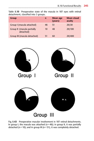 245
8.16 Functional Results
Fig. 8.43 Preoperative macular involvement in 107 retinal detachments.
In group I, the macula was attached (n = 46); in group II, it was partially
detached (n = 10); and in group III (n = 51), it was completely detached.
Table 8.10 Preoperative state of the macula in 107 eyes with retinal
detachment, classified into 3 groups.
Group n Mean age Mean visual
(years) acuity
Group I (macula attached) 46 51 20/30
Group II (macula partially
detached)
10 48 20/100
Group III (macula detached) 51 60 20/400
 