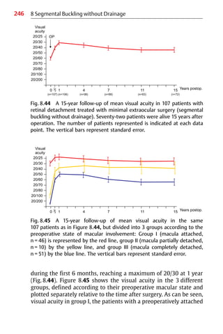 246 8 Segmental Buckling without Drainage
during the first 6 months, reaching a maximum of 20/30 at 1 year
(Fig. 8.44). Figure 8.45 shows the visual acuity in the 3 different
groups, defined according to their preoperative macular state and
plotted separately relative to the time after surgery. As can be seen,
visual acuity in group I, the patients with a preoperatively attached
Fig. 8.44 A 15-year follow-up of mean visual acuity in 107 patients with
retinal detachment treated with minimal extraocular surgery (segmental
buckling without drainage). Seventy-two patients were alive 15 years after
operation. The number of patients represented is indicated at each data
point. The vertical bars represent standard error.
Fig. 8.45 A 15-year follow-up of mean visual acuity in the same
107 patients as in Figure 8.44, but divided into 3 groups according to the
preoperative state of macular involvement: Group I (macula attached,
n = 46) is represented by the red line, group II (macula partially detached,
n = 10) by the yellow line, and group III (macula completely detached,
n = 51) by the blue line. The vertical bars represent standard error.
 