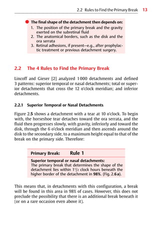 13
쎲 The final shape of the detachment then depends on:
1. The position of the primary break and the gravity
exerted on the subretinal fluid
2. The anatomical borders, such as the disk and the
ora serrata
3. Retinal adhesions, if present—e.g., after prophylac-
tic treatment or previous detachment surgery.
2.2 The 4 Rules to Find the Primary Break
Lincoff and Gieser [2] analyzed 1000 detachments and defined
3 patterns: superior temporal or nasal detachments; total or super-
ior detachments that cross the 12 o’clock meridian; and inferior
detachments.
2.2.1 Superior Temporal or Nasal Detachments
Figure 2.5 shows a detachment with a tear at 10 o’clock. To begin
with, the horseshoe tear detaches toward the ora serrata, and the
fluid then progresses slowly, with gravity, inferiorly and toward the
disk, through the 6 o’clock meridian and then ascends around the
disk to the secondary side, to a maximum height equal to that of the
break on the primary side. Therefore:
Primary Break: Rule 1
Superior temporal or nasal detachments:
The primary break that determines the shape of the
detachment lies within 11/2 clock hours beneath the
higher border of the detachment in 98%. (Fig. 2.6a).
This means that, in detachments with this configuration, a break
will be found in this area in 98% of cases. However, this does not
preclude the possibility that there is an additional break beneath it
(or on a rare occasion even above it).
2.2 Rules to Find the Primary Break
 
