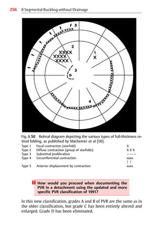 256
? How would you proceed when documenting the
PVR in a detachment using the updated and more
specific PVR classification of 1991?
In this new classification, grades A and B of PVR are the same as in
the older classification, but grade C has been entirely altered and
enlarged. Grade D has been eliminated.
8 Segmental Buckling without Drainage
Fig. 8.50 Retinal diagram depicting the various types of full-thickness re-
tinal folding, as published by Machemer et al [50].
Type 1 Focal contraction (starfold) X
Type 2 Diffuse contraction (group of starfolds) X X X
Type 3 Subretinal proliferation — — —
Type 4 Circumferential contraction xxxx
앖앖
Type 5 Anterior displacement by contraction xxxx
 