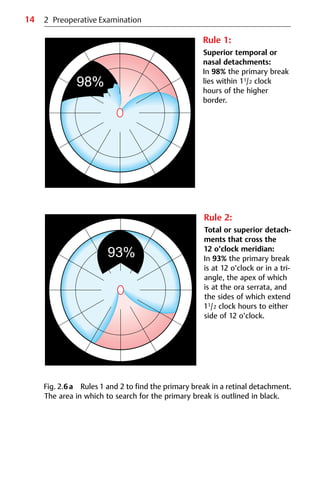14
Rule 1:
Superior temporal or
nasal detachments:
In 98% the primary break
lies within 11/2 clock
hours of the higher
border.
2 Preoperative Examination
Rule 2:
Total or superior detach-
ments that cross the
12 o’clock meridian:
In 93% the primary break
is at 12 o’clock or in a tri-
angle, the apex of which
is at the ora serrata, and
the sides of which extend
11/2 clock hours to either
side of 12 o’clock.
Fig. 2.6a Rules 1 and 2 to find the primary break in a retinal detachment.
The area in which to search for the primary break is outlined in black.
 