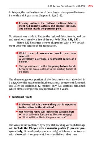 265
8.18 Retinal Detachments with PVR
In 24 eyes, the residual tractional detachment disappeared between
1 month and 5 years (see Chapter 8.13, p. 212).
쎲 In every instance, the residual tractional detach-
ment had concave surfaces and concave contours,
and did not invade the posterior pole.
No attempt was made to flatten the residual detachments, and the
end result was usually a line of dry starfolds (Figs. 8.51, 8.52).
Figure 8.53 illustrates the eye of a patient with a PVR detach-
ment who was sent to us for reoperation.
? Which type of reoperation would you have
selected?
A vitrectomy, a cerclage, a segmental buckle, or a
balloon?
왘 The eye was treated with a temporary balloon buckle
beneath the break, anterior to the existing buckle at
9 o’clock.
The rhegmatogenous portion of the detachment was absorbed in
3 days. Over the next 6 months, the tractional component flattened,
and after an additional 12 months only flat starfolds remained,
which almost completely disappeared after 4 years.
왘 Functional results
? In the end, what is the one thing that is important
to the patient in this situation?
왘 Not how the retina will look to the surgeon, but:
– What will visual function be like after surgery?
– What will it be like in the years to come?
The visual results obtained by segmental buckling without drainage
will include the 13 eyes with a macular pucker (1 present pre-
operatively, 12 developed postoperatively) which were not treated
with vitreoretinal surgery which was available at that time.
 
