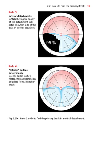 15
2.2 Rules to Find the Primary Break
Rule 3:
Inferior detachments:
In 95% the higher border
of the detachment indi-
cates on which side of the
disk an inferior break lies.
Rule 4:
“Inferior” bullous
detachments:
Inferior bullae in rheg-
matogenous detachments
originate from a superior
break.
Fig. 2.6b Rules 3 and 4 to find the primary break in a retinal detachment.
 