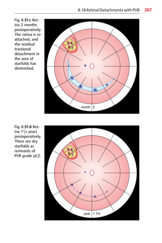 267
8.18 Retinal Detachments with PVR
Fig. 8.51c Ret-
ina 2 months
postoperatively.
The retina is re-
attached, and
the residual
tractional
detachment in
the area of
starfolds has
diminished.
Fig. 8.51d Ret-
ina 11/4 years
postoperatively.
There are dry
starfolds as
remnants of
PVR grade pC2.
 