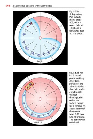 268 8 Segmental Buckling without Drainage
Fig. 8.52a
A 3-quadrant
PVR detach-
ment, grade
aC2, with a
round hole at
10:30 and a
horseshoe tear
at 11 o’clock.
Fig. 8.52b Ret-
ina 1 month
postoperatively.
After tam-
ponade of the
2 breaks with a
short circumfer-
ential buckle
without
drainage, the
retina reat-
tached except
for a concave re-
sidual tractional
detachment
from 3:30 over
6 to 10 o’clock.
The patient was
mobilized.
 