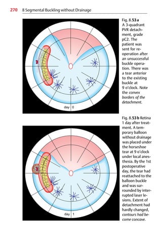 270 8 Segmental Buckling without Drainage
Fig. 8.53a
A 3-quadrant
PVR detach-
ment, grade
pC2. The
patient was
sent for re-
operation after
an unsuccessful
buckle opera-
tion. There was
a tear anterior
to the existing
buckle at
9 o’clock. Note
the convex
borders of the
detachment.
Fig. 8.53b Retina
1 day after treat-
ment. A tem-
porary balloon
without drainage
was placed under
the horseshoe
tear at 9 o’clock
under local anes-
thesia. By the 1st
postoperative
day, the tear had
reattached to the
balloon buckle
and was sur-
rounded by inter-
rupted laser le-
sions. Extent of
detachment had
hardly changed,
contours had be-
come concave.
 