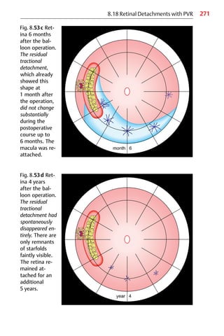 271
8.18 Retinal Detachments with PVR
Fig. 8.53c Ret-
ina 6 months
after the bal-
loon operation.
The residual
tractional
detachment,
which already
showed this
shape at
1 month after
the operation,
did not change
substantially
during the
postoperative
course up to
6 months. The
macula was re-
attached.
Fig. 8.53d Ret-
ina 4 years
after the bal-
loon operation.
The residual
tractional
detachment had
spontaneously
disappeared en-
tirely. There are
only remnants
of starfolds
faintly visible.
The retina re-
mained at-
tached for an
additional
5 years.
 