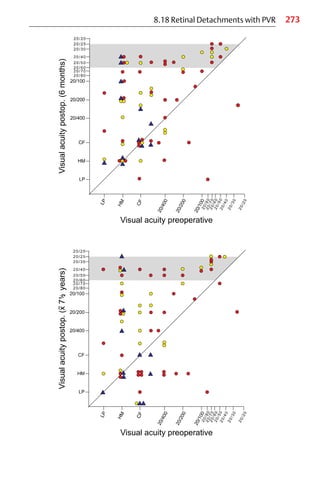 273
8.18 Retinal Detachments with PVR
 