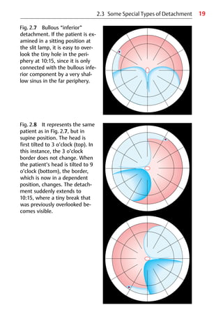 19
Fig. 2.7 Bullous “inferior”
detachment. If the patient is ex-
amined in a sitting position at
the slit lamp, it is easy to over-
look the tiny hole in the peri-
phery at 10:15, since it is only
connected with the bullous infe-
rior component by a very shal-
low sinus in the far periphery.
Fig. 2.8 It represents the same
patient as in Fig. 2.7, but in
supine position. The head is
first tilted to 3 o’clock (top). In
this instance, the 3 o’clock
border does not change. When
the patient’s head is tilted to 9
o’clock (bottom), the border,
which is now in a dependent
position, changes. The detach-
ment suddenly extends to
10:15, where a tiny break that
was previously overlooked be-
comes visible.
2.3 Some Special Types of Detachment
 