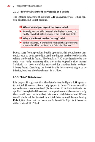 20
2.3.2 Inferior Detachment in Presence of a Buckle
The inferior detachment in Figure 2.10 is asymmetrical; it has con-
vex borders, but is not bullous.
? Where would you expect the break to be?
왘 Actually, on the side beneath the higher border, i.e.,
on the 3 o’clock side. However, the break is at 7:30.
? Why is the break on the “wrong” side?
왘 In this instance, it should be recalled that preexisting
scars or buckles can interrupt fluid distribution.
Due to scars from a previous buckle operation, this detachment can-
not (as was to be expected) ascend any higher on the 8 o’clock side,
where the break is found. The break at 7:30 may therefore be the
only 1—but only assuming that the entire opposite side toward
3 o’clock has been carefully searched for another hole, without
1 being found. Certainly, the break in this detachment ought to be
inferior, because the detachment is shallow.
2.3.3 “Total” Detachment
It is only at first glance that the detachment in Figure 2.11 appears
to be total. However, this can only appear to be so if the entire retina
up to the ora is not examined (for instance, if the indentation is not
applied through the lid to make the superior ora visible)—since only
then could one conclude that this was a total detachment. Where
would the break be located in a total detachment? Remembering
Rule 2, it is clear that the break would be within 11/2 clock hours on
either side of 12 o’clock.
2 Preoperative Examination
 