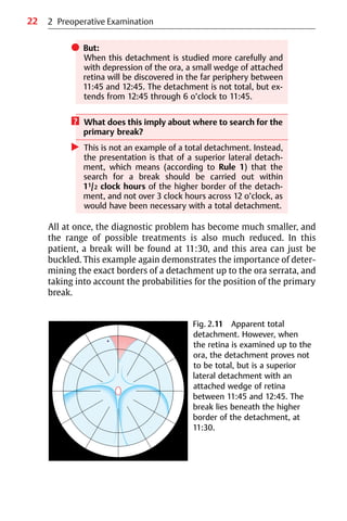 22
쎲 But:
When this detachment is studied more carefully and
with depression of the ora, a small wedge of attached
retina will be discovered in the far periphery between
11:45 and 12:45. The detachment is not total, but ex-
tends from 12:45 through 6 o’clock to 11:45.
? What does this imply about where to search for the
primary break?
왘 This is not an example of a total detachment. Instead,
the presentation is that of a superior lateral detach-
ment, which means (according to Rule 1) that the
search for a break should be carried out within
11/2 clock hours of the higher border of the detach-
ment, and not over 3 clock hours across 12 o’clock, as
would have been necessary with a total detachment.
All at once, the diagnostic problem has become much smaller, and
the range of possible treatments is also much reduced. In this
patient, a break will be found at 11:30, and this area can just be
buckled. This example again demonstrates the importance of deter-
mining the exact borders of a detachment up to the ora serrata, and
taking into account the probabilities for the position of the primary
break.
Fig. 2.11 Apparent total
detachment. However, when
the retina is examined up to the
ora, the detachment proves not
to be total, but is a superior
lateral detachment with an
attached wedge of retina
between 11:45 and 12:45. The
break lies beneath the higher
border of the detachment, at
11:30.
2 Preoperative Examination
 
