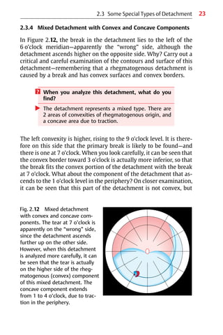 23
2.3.4 Mixed Detachment with Convex and Concave Components
In Figure 2.12, the break in the detachment lies to the left of the
6 o’clock meridian—apparently the “wrong” side, although the
detachment ascends higher on the opposite side. Why? Carry out a
critical and careful examination of the contours and surface of this
detachment—remembering that a rhegmatogenous detachment is
caused by a break and has convex surfaces and convex borders.
? When you analyze this detachment, what do you
find?
왘 The detachment represents a mixed type. There are
2 areas of convexities of rhegmatogenous origin, and
a concave area due to traction.
The left convexity is higher, rising to the 9 o’clock level. It is there-
fore on this side that the primary break is likely to be found—and
there is one at 7 o’clock. When you look carefully, it can be seen that
the convex border toward 3 o’clock is actually more inferior, so that
the break fits the convex portion of the detachment with the break
at 7 o’clock. What about the component of the detachment that as-
cends to the 1 o’clock level in the periphery? On closer examination,
it can be seen that this part of the detachment is not convex, but
Fig. 2.12 Mixed detachment
with convex and concave com-
ponents. The tear at 7 o’clock is
apparently on the “wrong” side,
since the detachment ascends
further up on the other side.
However, when this detachment
is analyzed more carefully, it can
be seen that the tear is actually
on the higher side of the rheg-
matogenous (convex) component
of this mixed detachment. The
concave component extends
from 1 to 4 o’clock, due to trac-
tion in the periphery.
2.3 Some Special Types of Detachment
 