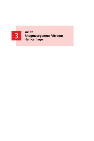 27
3
Acute
Rhegmatogenous Vitreous
Hemorrhage
Acute
Rhegmatogenous Vitreous
Hemorrhage
 