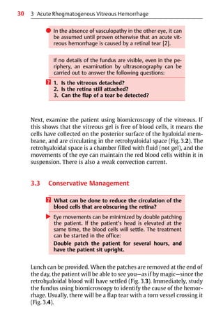 30
쎲 In the absence of vasculopathy in the other eye, it can
be assumed until proven otherwise that an acute vit-
reous hemorrhage is caused by a retinal tear [2].
If no details of the fundus are visible, even in the pe-
riphery, an examination by ultrasonography can be
carried out to answer the following questions:
? 1. Is the vitreous detached?
2. Is the retina still attached?
3. Can the flap of a tear be detected?
Next, examine the patient using biomicroscopy of the vitreous. If
this shows that the vitreous gel is free of blood cells, it means the
cells have collected on the posterior surface of the hyaloidal mem-
brane, and are circulating in the retrohyaloidal space (Fig. 3.2). The
retrohyaloidal space is a chamber filled with fluid (not gel), and the
movements of the eye can maintain the red blood cells within it in
suspension. There is also a weak convection current.
3.3 Conservative Management
? What can be done to reduce the circulation of the
blood cells that are obscuring the retina?
왘 Eye movements can be minimized by double patching
the patient. If the patient’s head is elevated at the
same time, the blood cells will settle. The treatment
can be started in the office:
Double patch the patient for several hours, and
have the patient sit upright.
Lunch can be provided. When the patches are removed at the end of
the day, the patient will be able to see you—as if by magic—since the
retrohyaloidal blood will have settled (Fig. 3.3). Immediately, study
the fundus using biomicroscopy to identify the cause of the hemor-
rhage. Usually, there will be a flap tear with a torn vessel crossing it
(Fig. 3.4).
3 Acute Rhegmatogenous Vitreous Hemorrhage
 
