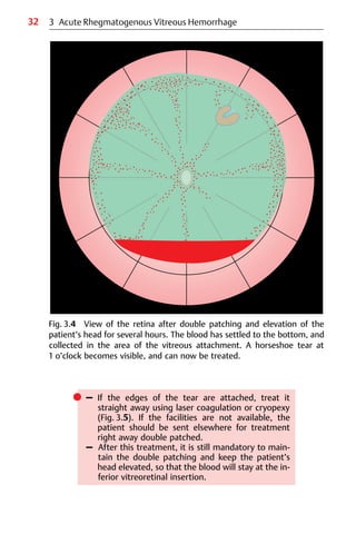 32 3 Acute Rhegmatogenous Vitreous Hemorrhage
Fig. 3.4 View of the retina after double patching and elevation of the
patient’s head for several hours. The blood has settled to the bottom, and
collected in the area of the vitreous attachment. A horseshoe tear at
1 o’clock becomes visible, and can now be treated.
쎲 – If the edges of the tear are attached, treat it
straight away using laser coagulation or cryopexy
(Fig. 3.5). If the facilities are not available, the
patient should be sent elsewhere for treatment
right away double patched.
– After this treatment, it is still mandatory to main-
tain the double patching and keep the patient’s
head elevated, so that the blood will stay at the in-
ferior vitreoretinal insertion.
 
