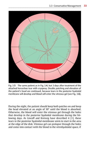 33
3.3 Conservative Management
During the night, the patient should keep both patches on and keep
the head elevated at an angle of 30° until the blood is absorbed.
Otherwise, the blood will enter the vitreous gel through the holes
that develop in the posterior hyaloidal membrane during the fol-
lowing days. As Lincoff and Kreissig have described it [1], these
tears in the posterior hyaloidal membrane seem to start in the area
at the edge of the disk. Vitreous gel can prolapse through the holes
and come into contact with the blood in the retrohyaloidal space, if
Fig. 3.5 The same patient as in Fig. 3.4, but 3 days after treatment of the
attached horseshoe tear with cryopexy. Double patching and elevation of
the patient’s head are continued, because tears in the posterior hyaloidal
membrane will develop and blood will enter the vitreous gel (see Fig. 3.6).
 
