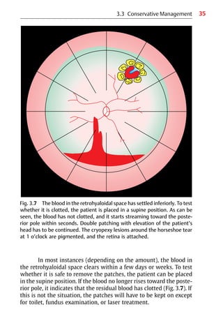 35
3.3 Conservative Management
In most instances (depending on the amount), the blood in
the retrohyaloidal space clears within a few days or weeks. To test
whether it is safe to remove the patches, the patient can be placed
in the supine position. If the blood no longer rises toward the poste-
rior pole, it indicates that the residual blood has clotted (Fig. 3.7). If
this is not the situation, the patches will have to be kept on except
for toilet, fundus examination, or laser treatment.
Fig. 3.7 The blood in the retrohyaloidal space has settled inferiorly. To test
whether it is clotted, the patient is placed in a supine position. As can be
seen, the blood has not clotted, and it starts streaming toward the poste-
rior pole within seconds. Double patching with elevation of the patient’s
head has to be continued. The cryopexy lesions around the horseshoe tear
at 1 o’clock are pigmented, and the retina is attached.
 