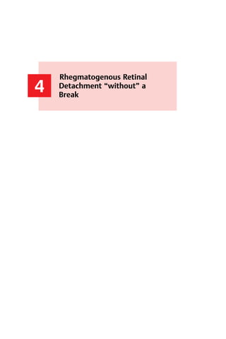 41
4
Rhegmatogenous Retinal
Detachment “without” a
Break
4 Rhegmatogenous Detachment “without” a Break
 