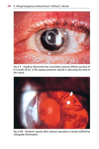 44
Fig. 4.1 Pupillary obstruction by a secondary cataract (Photo courtesy of
H. Lincoff, M.D.). a The opaque posterior capsule is obscuring the view to
the retina.
Fig. 4.1b Posterior capsule after cataract operation is clearly outlined by
retrograde illumination.
4 Rhegmatogenous Detachment “without” a Break
 