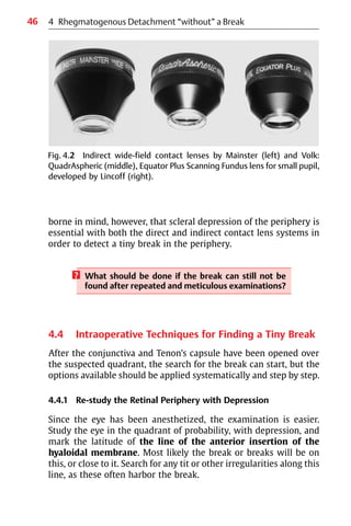 46
borne in mind, however, that scleral depression of the periphery is
essential with both the direct and indirect contact lens systems in
order to detect a tiny break in the periphery.
? What should be done if the break can still not be
found after repeated and meticulous examinations?
4.4 Intraoperative Techniques for Finding a Tiny Break
After the conjunctiva and Tenon’s capsule have been opened over
the suspected quadrant, the search for the break can start, but the
options available should be applied systematically and step by step.
4.4.1 Re-study the Retinal Periphery with Depression
Since the eye has been anesthetized, the examination is easier.
Study the eye in the quadrant of probability, with depression, and
mark the latitude of the line of the anterior insertion of the
hyaloidal membrane. Most likely the break or breaks will be on
this, or close to it. Search for any tit or other irregularities along this
line, as these often harbor the break.
Fig. 4.2 Indirect wide-field contact lenses by Mainster (left) and Volk:
QuadrAspheric (middle), Equator Plus Scanning Fundus lens for small pupil,
developed by Lincoff (right).
4 Rhegmatogenous Detachment “without” a Break
 
