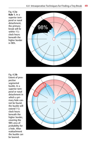 49
Fig. 4.3a
Rule 1. In a
superior tem-
poral or nasal
detachment,
the primary
break will lie
within 11/2
clock hours
beneath the
higher border
in 98%.
Fig. 4.3b
Extent of pros-
pective
segmental
buckle. In a
superior tem-
poral or nasal
detachment in
which a pri-
mary hole can-
not be found,
the buckle will
extend 11/2
clock hours
beneath the
higher border,
covering the
98% area of
probability for
a hole. After
reattachment
the buckle can
be lasered.
4.4 Intraoperative Techniques for Finding a Tiny Break
 