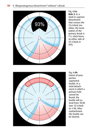 50 4 Rhegmatogenous Detachment “without” a Break
Fig. 4.4a
Rule 2. In a
total or superior
detachment
that crosses the
12 o’clock me-
ridian, the local-
ization of the
primary break is
11/2 clock hours
to either side of
12 o’clock in
93%.
Fig. 4.4b
Extent of pros-
pective
segmental
buckle. In a
total detach-
ment in which a
primary hole
cannot be
found, the
buckle will ex-
tend from 10:30
over 12 o’clock
to 1:30. After
reattachment
the buckle can
be lasered.
 