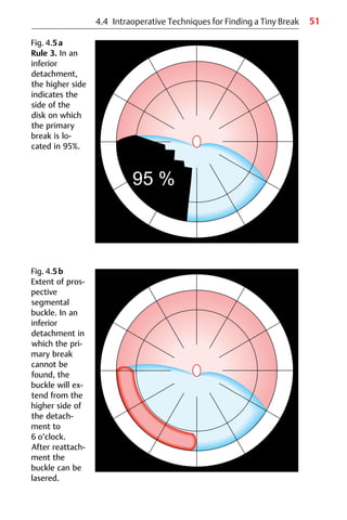 51
4.4 Intraoperative Techniques for Finding a Tiny Break
Fig. 4.5a
Rule 3. In an
inferior
detachment,
the higher side
indicates the
side of the
disk on which
the primary
break is lo-
cated in 95%.
Fig. 4.5b
Extent of pros-
pective
segmental
buckle. In an
inferior
detachment in
which the pri-
mary break
cannot be
found, the
buckle will ex-
tend from the
higher side of
the detach-
ment to
6 o’clock.
After reattach-
ment the
buckle can be
lasered.
 