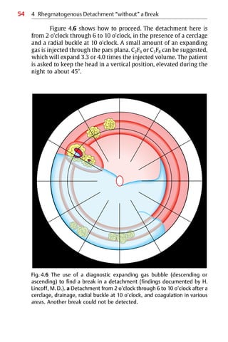 54 4 Rhegmatogenous Detachment “without” a Break
Fig. 4.6 The use of a diagnostic expanding gas bubble (descending or
ascending) to find a break in a detachment (findings documented by H.
Lincoff, M.D.). a Detachment from 2 o’clock through 6 to 10 o’clock after a
cerclage, drainage, radial buckle at 10 o’clock, and coagulation in various
areas. Another break could not be detected.
Figure 4.6 shows how to proceed. The detachment here is
from 2 o’clock through 6 to 10 o’clock, in the presence of a cerclage
and a radial buckle at 10 o’clock. A small amount of an expanding
gas is injected through the pars plana. C2F6 or C3F8 can be suggested,
which will expand 3.3 or 4.0 times the injected volume. The patient
is asked to keep the head in a vertical position, elevated during the
night to about 45°.
 