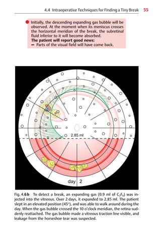 55
4.4 Intraoperative Techniques for Finding a Tiny Break
Fig. 4.6b To detect a break, an expanding gas (0.9 ml of C2F6) was in-
jected into the vitreous. Over 2 days, it expanded to 2.85 ml. The patient
slept in an elevated position (45°), and was able to walk around during the
day. When the gas bubble crossed the 10 o’clock meridian, the retina sud-
denly reattached. The gas bubble made a vitreous traction line visible, and
leakage from the horseshoe tear was suspected.
쎲 Initially, the descending expanding gas bubble will be
observed. At the moment when its meniscus crosses
the horizontal meridian of the break, the subretinal
fluid inferior to it will become absorbed.
The patient will report good news:
– Parts of the visual field will have come back.
 
