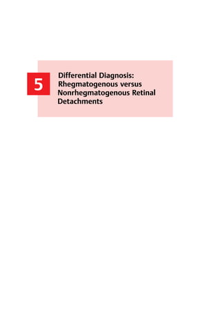 63
5
Differential Diagnosis:
Rhegmatogenous versus
Nonrhegmatogenous Retinal
Detachments
4.5 Summary
 