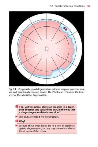 65
Fig. 5.1 Peripheral cystoid degeneration, with an irregular posterior con-
vex and occasionally concave border. The 2 holes at 1:15 are in the inner
layer of the schisis-like degeneration.
? If so, will this retinal elevation progress in a depen-
dent direction and toward the disk, in the way that
a rhegmatogenous detachment does?
왘 The odds are that it will not progress.
? Why?
왘 Because these small holes are in a line of peripheral
cystoid degeneration, so that they are only in the in-
ternal layers of the retina.
5.1 Peripheral Retinal Elevations
 