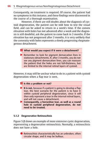 66
Consequently, no treatment is required. Of course, the patient had
no symptoms in this instance, and these findings were discovered in
the course of a thorough examination.
However, if there are still doubts about the diagnosis of cys-
toid degeneration, the patient can be told how to test the visual
field, and can be asked to return in a week’s time. If the convex
elevation with holes has not advanced after a week and the diagno-
sis is still doubtful, ask the patient to come back in 3 months. If the
elevation has not progressed after 3 months, it is very unlikely that
the convexity with holes represents a slowly progressing rhegmato-
genous detachment.
? What would you expect if it were a detachment?
왘 Remember to look for pigment demarcation lines in
stationary detachments. If, after 3 months, you do not
see any pigment demarcation lines, you can reassure
the patient that the holes are not full-thickness, but
are limited to the internal retinal layers of cystoid.
However, it may still be unclear what to do in a patient with cystoid
degeneration when a flap tear is seen.
? Is this a problem or not?
왘 It is not, because if a patient is going to develop a flap
tear, the best scenario for the patient is to have it
within cystoid peripheral degeneration, since it will
then only represent a tear in the internal retinal layers,
and will not cause a detachment.
왘 Consequently, a horseshoe tear, as well as a round
hole in cystoid peripheral degeneration, do not
need to be treated.
5.1.2 Degenerative Retinoschisis
Figure 5.2 shows an example of more extensive cystic degeneration,
representing a degenerative retinoschisis. Normally, a retinoschisis
does not have a hole.
쎲 Retinoschisis characteristically has an unbroken, often
circular shape, and it may be bullous.
5 Rhegmatogenous versus Nonrhegmatogenous Detachment
 