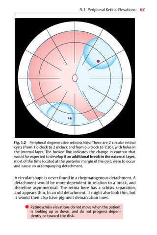 67
A circular shape is never found in a rhegmatogenous detachment. A
detachment would be more dependent in relation to a break, and
therefore asymmetrical. The retina here has a schisis separation,
and appears thin. In an old detachment, it might also look thin, but
it would then also have pigment demarcation lines.
쎲 Retinoschisis elevations do not move when the patient
is looking up or down, and do not progress depen-
dently or toward the disk.
Fig. 5.2 Peripheral degenerative retinoschisis: There are 2 circular retinal
cysts (from 1 o’clock to 2 o’clock and from 6 o’clock to 7:30), with holes in
the internal layer. The broken line indicates the change in contour that
would be expected to develop if an additional break in the external layer,
most of the time located at the posterior margin of the cyst, were to occur
and cause an accompanying detachment.
5.1 Peripheral Retinal Elevations
 