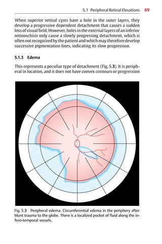 69
When superior retinal cysts have a hole in the outer layers, they
develop a progressive dependent detachment that causes a sudden
loss of visual field. However, holes in the external layers of an inferior
retinoschisis only cause a slowly progressing detachment, which is
oftennotrecognizedbythepatientandwhichmaythereforedevelop
successive pigmentation lines, indicating its slow progression.
5.1.3 Edema
This represents a peculiar type of detachment (Fig. 5.3). It is periph-
eral in location, and it does not have convex contours or progression
Fig. 5.3 Peripheral edema. Circumferential edema in the periphery after
blunt trauma to the globe. There is a localized pocket of fluid along the in-
fero-temporal vessels.
5.1 Peripheral Retinal Elevations
 