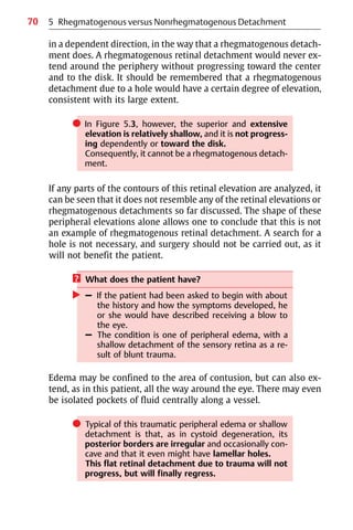 70
in a dependent direction, in the way that a rhegmatogenous detach-
ment does. A rhegmatogenous retinal detachment would never ex-
tend around the periphery without progressing toward the center
and to the disk. It should be remembered that a rhegmatogenous
detachment due to a hole would have a certain degree of elevation,
consistent with its large extent.
쎲 In Figure 5.3, however, the superior and extensive
elevation is relatively shallow, and it is not progress-
ing dependently or toward the disk.
Consequently, it cannot be a rhegmatogenous detach-
ment.
If any parts of the contours of this retinal elevation are analyzed, it
can be seen that it does not resemble any of the retinal elevations or
rhegmatogenous detachments so far discussed. The shape of these
peripheral elevations alone allows one to conclude that this is not
an example of rhegmatogenous retinal detachment. A search for a
hole is not necessary, and surgery should not be carried out, as it
will not benefit the patient.
? What does the patient have?
왘 – If the patient had been asked to begin with about
the history and how the symptoms developed, he
or she would have described receiving a blow to
the eye.
– The condition is one of peripheral edema, with a
shallow detachment of the sensory retina as a re-
sult of blunt trauma.
Edema may be confined to the area of contusion, but can also ex-
tend, as in this patient, all the way around the eye. There may even
be isolated pockets of fluid centrally along a vessel.
쎲 Typical of this traumatic peripheral edema or shallow
detachment is that, as in cystoid degeneration, its
posterior borders are irregular and occasionally con-
cave and that it even might have lamellar holes.
This flat retinal detachment due to trauma will not
progress, but will finally regress.
5 Rhegmatogenous versus Nonrhegmatogenous Detachment
 