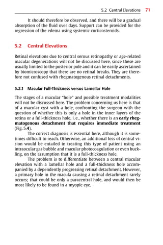 71
It should therefore be observed, and there will be a gradual
absorption of the fluid over days. Support can be provided for the
regression of the edema using systemic corticosteroids.
5.2 Central Elevations
Retinal elevations due to central serous retinopathy or age-related
macular degenerations will not be discussed here, since these are
usually limited to the posterior pole and it can be easily ascertained
by biomicroscopy that there are no retinal breaks. They are there-
fore not confused with rhegmatogenous retinal detachments.
5.2.1 Macular Full-Thickness versus Lamellar Hole
The stages of a macular “hole” and possible treatment modalities
will not be discussed here. The problem concerning us here is that
of a macular cyst with a hole, confronting the surgeon with the
question of whether this is only a hole in the inner layers of the
retina or a full-thickness hole, i. e., whether there is an early rheg-
matogenous detachment that requires immediate treatment
(Fig. 5.4).
The correct diagnosis is essential here, although it is some-
times difficult to reach. Otherwise, an additional loss of central vi-
sion would be entailed in treating this type of patient using an
intraocular gas bubble and macular photocoagulation or even buck-
ling, on the assumption that it is a full-thickness hole.
The problem is to differentiate between a central macular
elevation with a lamellar hole and a full-thickness hole accom-
panied by a dependently progressing retinal detachment. However,
a primary hole in the macula causing a retinal detachment rarely
occurs; that could be only a paracentral hole, and would then be
most likely to be found in a myopic eye.
5.2 Central Elevations
 