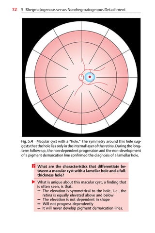 72
? What are the characteristics that differentiate be-
tween a macular cyst with a lamellar hole and a full-
thickness hole?
왘 What is unique about this macular cyst, a finding that
is often seen, is that:
– The elevation is symmetrical to the hole, i. e., the
retina is equally elevated above and below
– The elevation is not dependent in shape
– Will not progress dependently
– It will never develop pigment demarcation lines.
Fig. 5.4 Macular cyst with a “hole.” The symmetry around this hole sug-
geststhattheholeliesonlyintheinternallayeroftheretina.Duringthelong-
term follow-up, the non-dependent progression and the non-development
of a pigment demarcation line confirmed the diagnosis of a lamellar hole.
5 Rhegmatogenous versus Nonrhegmatogenous Detachment
 