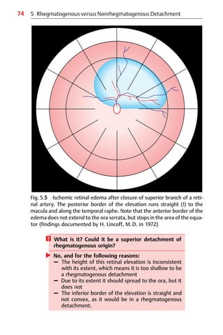 74
Fig. 5.5 Ischemic retinal edema after closure of superior branch of a reti-
nal artery. The posterior border of the elevation runs straight (!) to the
macula and along the temporal raphe. Note that the anterior border of the
edema does not extend to the ora serrata, but stops in the area of the equa-
tor (findings documented by H. Lincoff, M.D. in 1972)
5 Rhegmatogenous versus Nonrhegmatogenous Detachment
? What is it? Could it be a superior detachment of
rhegmatogenous origin?
왘 No, and for the following reasons:
– The height of this retinal elevation is inconsistent
with its extent, which means it is too shallow to be
a rhegmatogenous detachment
– Due to its extent it should spread to the ora, but it
does not
– The inferior border of the elevation is straight and
not convex, as it would be in a rhegmatogenous
detachment.
 