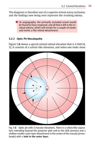 75
Fig. 5.6 Optic pit with 2 macular elevations. There is a schisis-like separa-
tion extending beyond the posterior pole and to the disk (arrows) and a
shallow smaller outer layer detachment in the center of the macula (arrow-
heads) with a hole in the outer layer.
5.2 Central Elevations
The diagnosis is therefore one of a superior retinal artery occlusion,
and the findings now being seen represent the resulting edema.
쎲 At angiography, the primarily occluded vessel would
be found to have reopened, and all that is left is the re-
sidual edema, which will remain for a couple of weeks
and mimic a flat retinal detachment.
5.2.3 Optic Pit Maculopathy
Figure 5.6 shows a special central retinal elevation that is 2-fold [4,
5]. It consists of a schisis-like elevation, and when one looks more
 