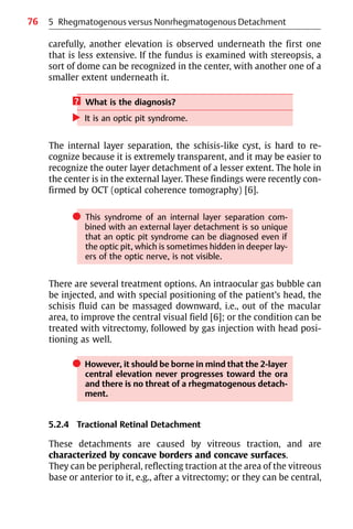 76
carefully, another elevation is observed underneath the first one
that is less extensive. If the fundus is examined with stereopsis, a
sort of dome can be recognized in the center, with another one of a
smaller extent underneath it.
? What is the diagnosis?
왘 It is an optic pit syndrome.
The internal layer separation, the schisis-like cyst, is hard to re-
cognize because it is extremely transparent, and it may be easier to
recognize the outer layer detachment of a lesser extent. The hole in
the center is in the external layer. These findings were recently con-
firmed by OCT (optical coherence tomography) [6].
쎲 This syndrome of an internal layer separation com-
bined with an external layer detachment is so unique
that an optic pit syndrome can be diagnosed even if
the optic pit, which is sometimes hidden in deeper lay-
ers of the optic nerve, is not visible.
There are several treatment options. An intraocular gas bubble can
be injected, and with special positioning of the patient’s head, the
schisis fluid can be massaged downward, i.e., out of the macular
area, to improve the central visual field [6]; or the condition can be
treated with vitrectomy, followed by gas injection with head posi-
tioning as well.
쎲 However, it should be borne in mind that the 2-layer
central elevation never progresses toward the ora
and there is no threat of a rhegmatogenous detach-
ment.
5.2.4 Tractional Retinal Detachment
These detachments are caused by vitreous traction, and are
characterized by concave borders and concave surfaces.
They can be peripheral, reflecting traction at the area of the vitreous
base or anterior to it, e.g., after a vitrectomy; or they can be central,
5 Rhegmatogenous versus Nonrhegmatogenous Detachment
 