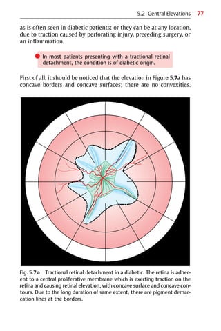 77
Fig. 5.7a Tractional retinal detachment in a diabetic. The retina is adher-
ent to a central proliferative membrane which is exerting traction on the
retina and causing retinal elevation, with concave surface and concave con-
tours. Due to the long duration of same extent, there are pigment demar-
cation lines at the borders.
as is often seen in diabetic patients; or they can be at any location,
due to traction caused by perforating injury, preceding surgery, or
an inflammation.
쎲 In most patients presenting with a tractional retinal
detachment, the condition is of diabetic origin.
First of all, it should be noticed that the elevation in Figure 5.7a has
concave borders and concave surfaces; there are no convexities.
5.2 Central Elevations
 